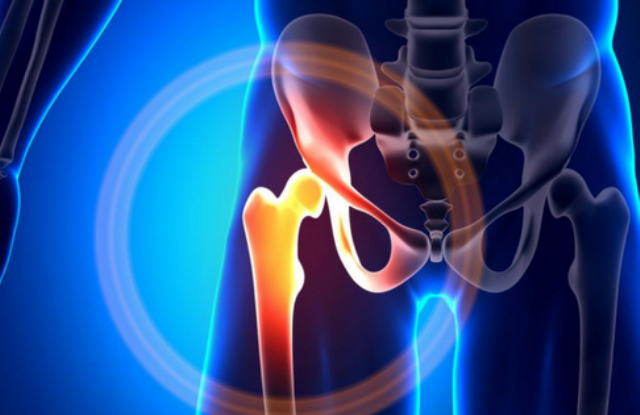 Editoriale salute. Artrosi dell’anca: insorgenza ed evoluzione della patologia (prima parte)